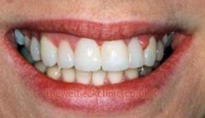 emily invisalign london