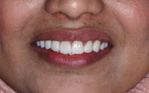 Anya porcelain veneers london