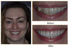 sophie veneers