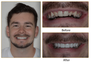 Jonathan Porcelain veneers