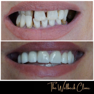 Maggie Porcelain veneers