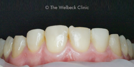 Cosmetic Bonding
