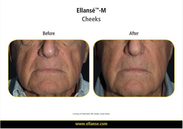 Ellanse Before After