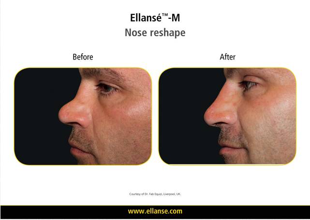 Ellanse Before After