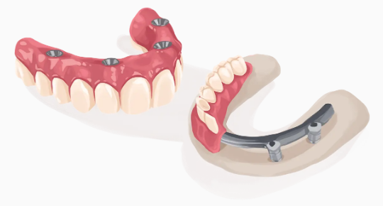 Dental Implants