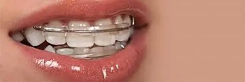 Inman Aligner