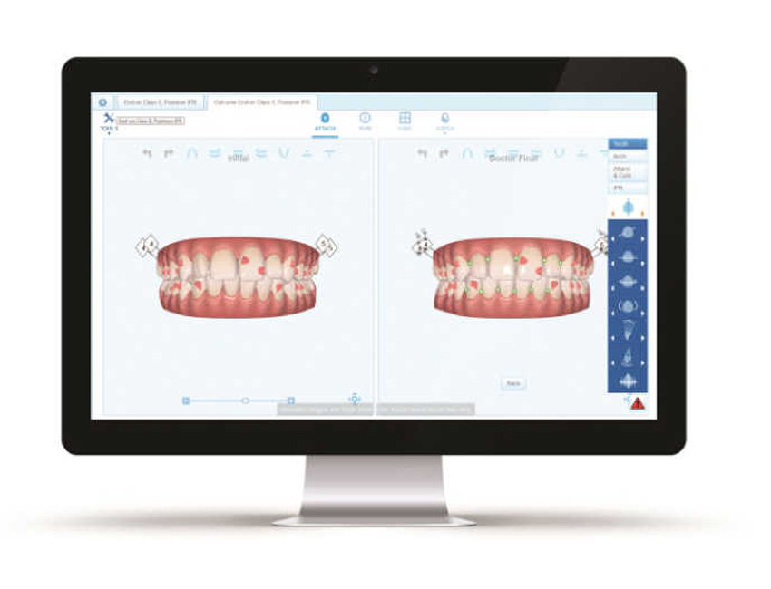 Invisalign