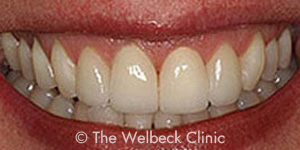 Crowded Uneven Teeth